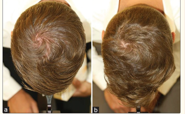 Does Dandruff cause Hair Loss?