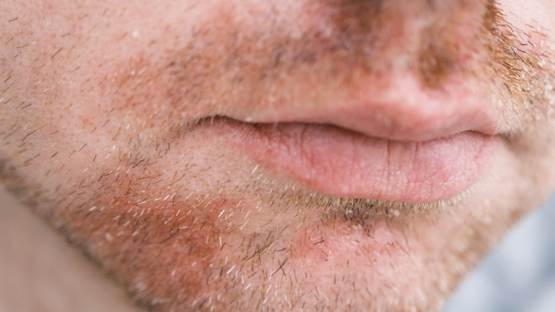 Dry skin on your face? It could be dandruff!